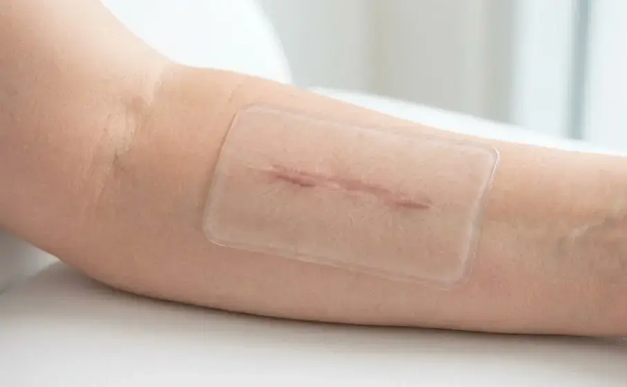 Transparent silicone gel sheet applied on skin, scar treatment concept, medical skincare product, clean background, close-up detail. -Silicone Gel Manufacturers. -1