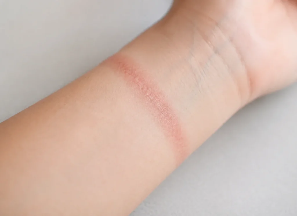 Mild red rash on forearm associated with possible silicone allergy - silicone allergy -1